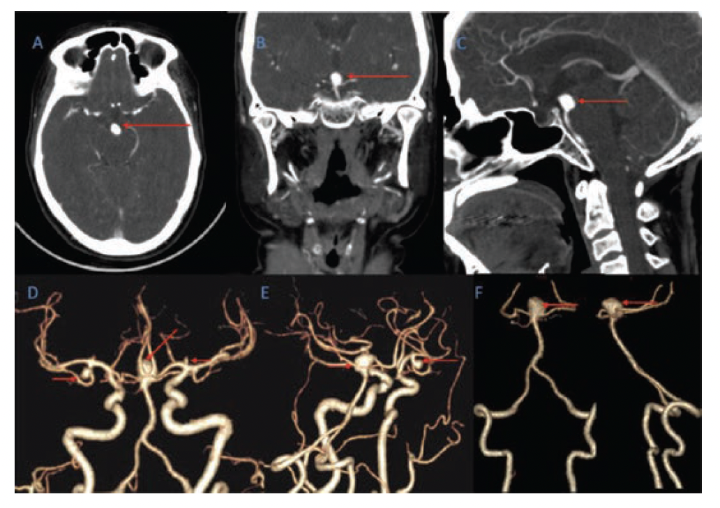 CoilAssisted Flow Diversion in a Ruptured Aneurysm VDM
